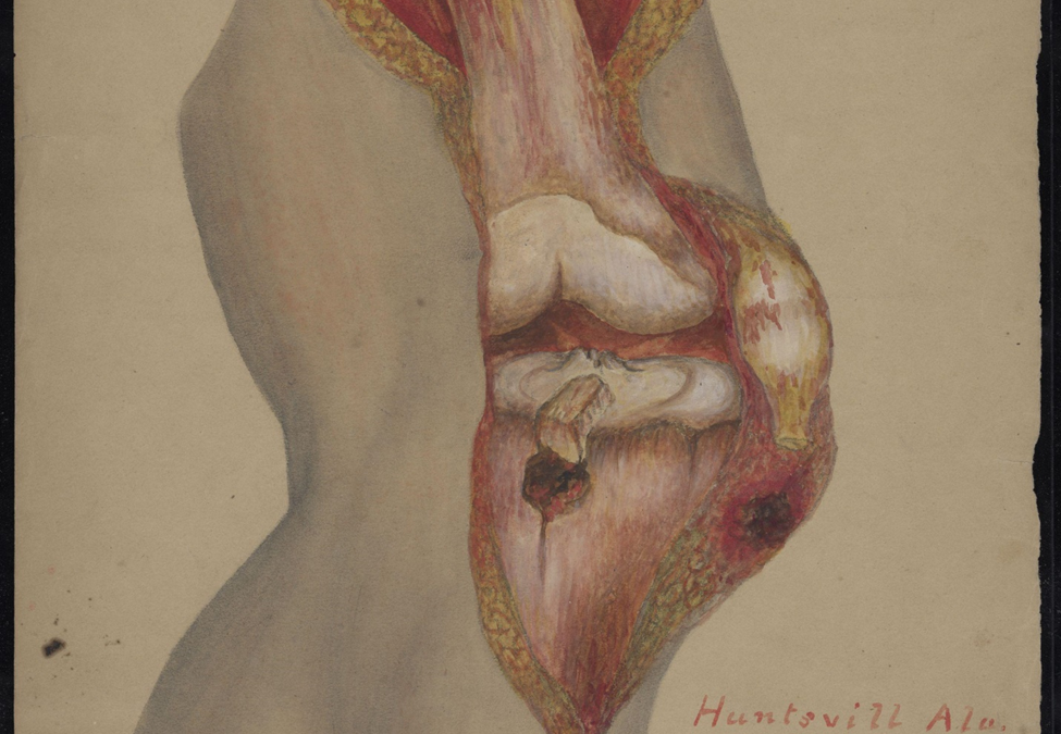 Entry wound below the knee joint on the lower leg. Huntsville, Alabama.