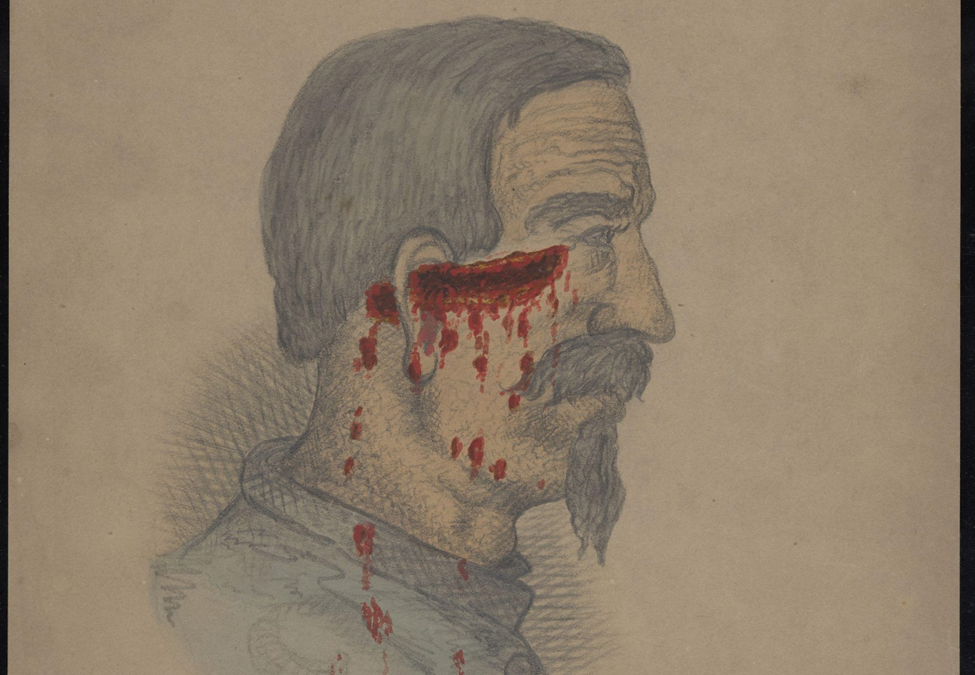 Sharp instrument wound along the side of the face and into the ear. Dug Gap, Georgia.