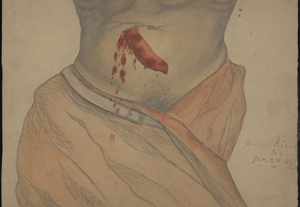 Sharp instrument wound on the lower abdomen. Stone's River, Tennessee.