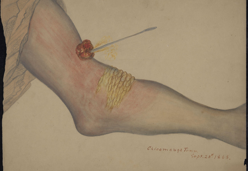 Upper arm wound with an instrument lodged in the wound. Chickamauga, Tennessee.