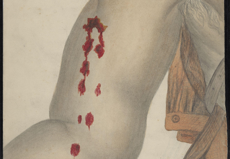 Cuts along the upper arm and elbow. Stone's River, Tennessee.