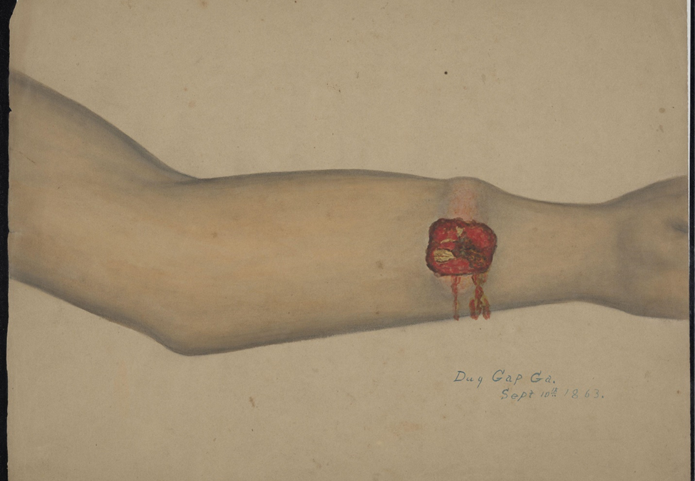 Forearm injury with no entry or exit wound. Dug Gap, Georgia.