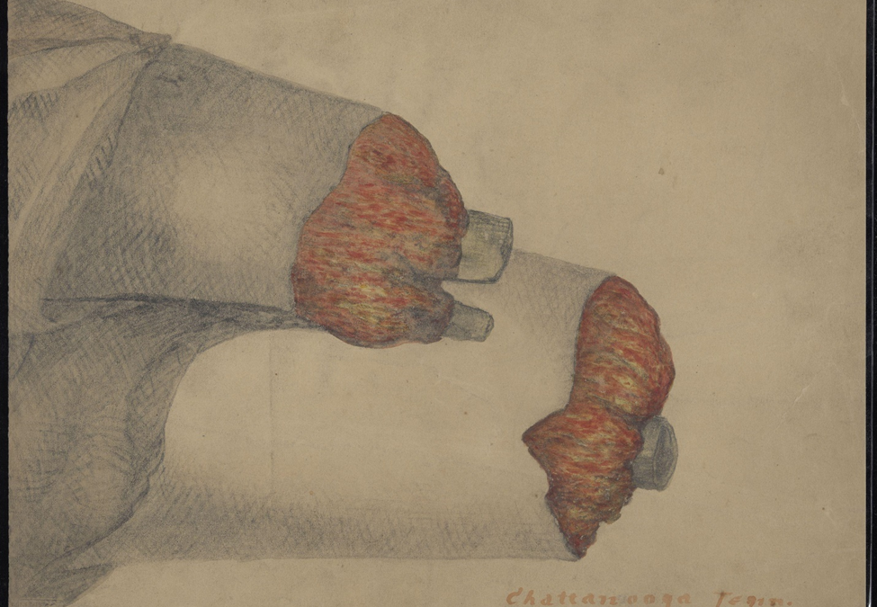 Bilateral above-knee and forearm amputations. Chattanooga, Tennessee.