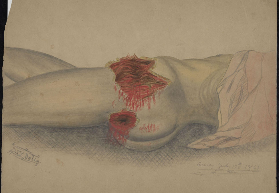 Flesh wounds in the buttock and hip area. Scary Creek, Virginia.