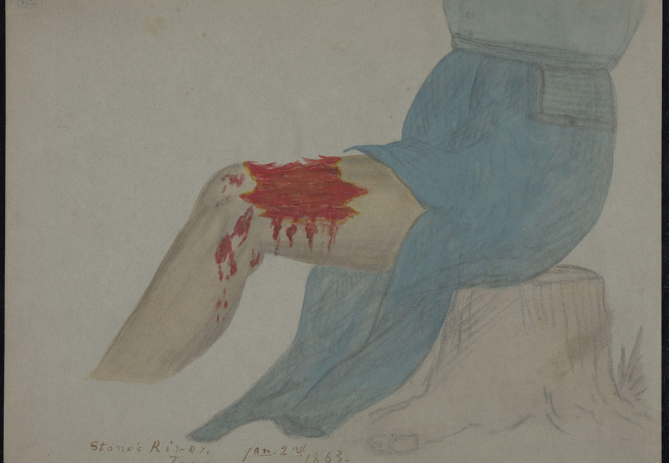 Deep flesh wounds on the thigh and upper calf. Stone's River, Tennessee.