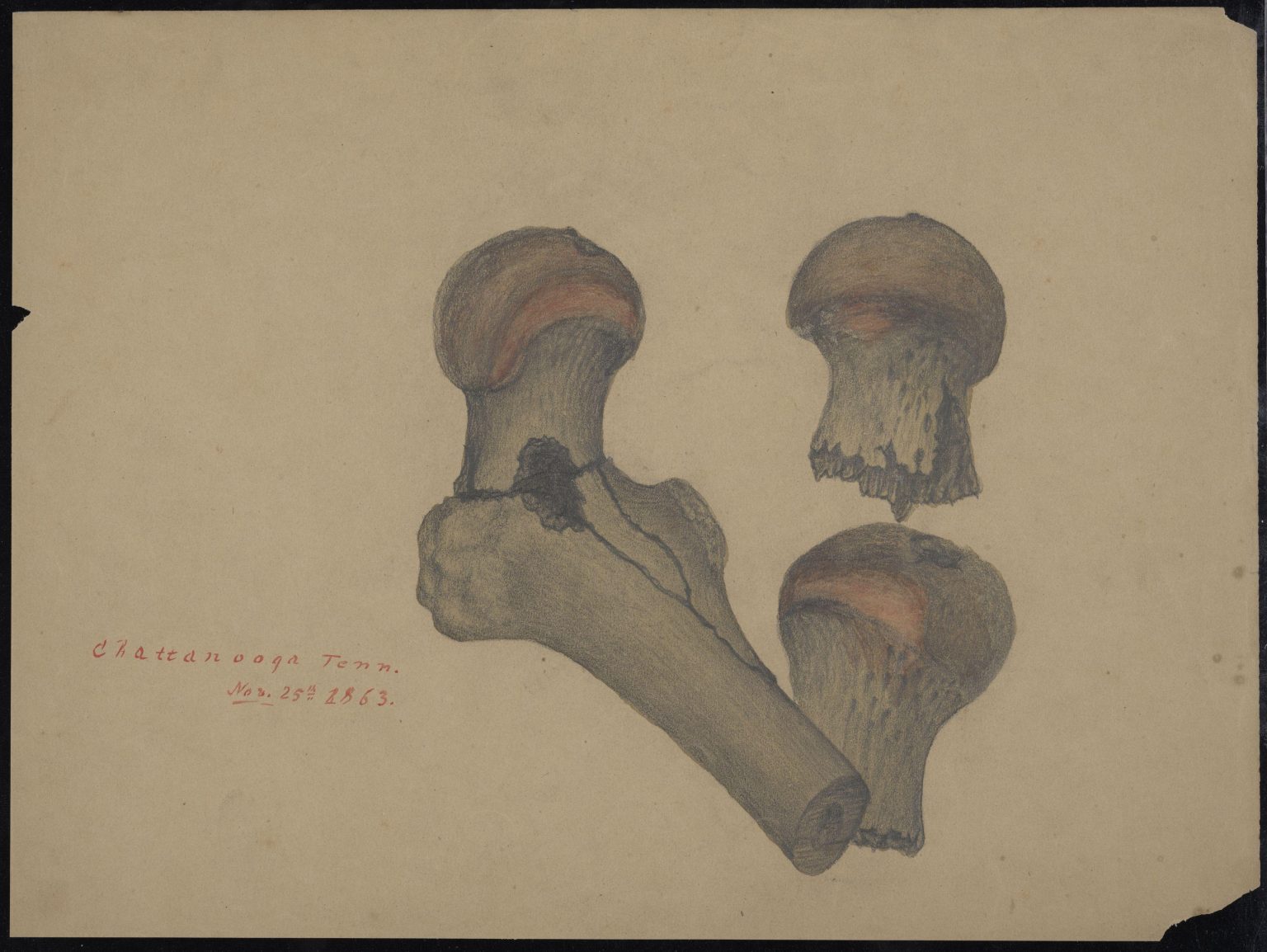 Color drawing of a femur broken by bullet wound.