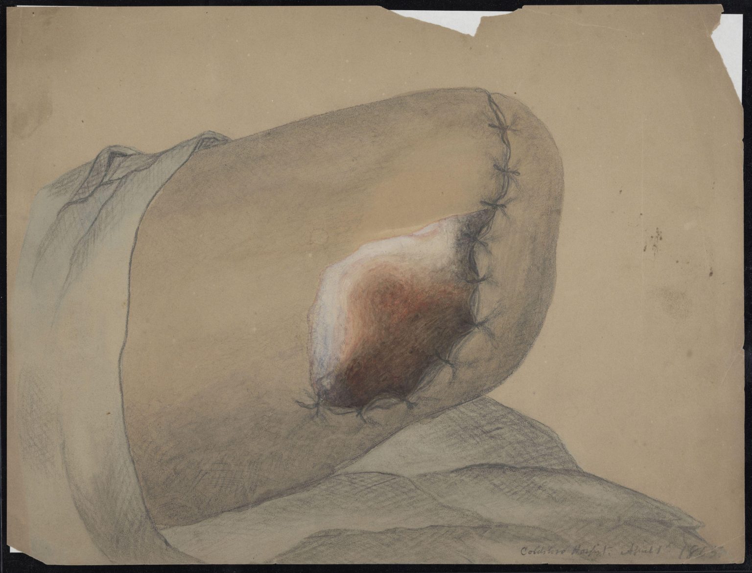 Color drawing of an amputation of the distal femur